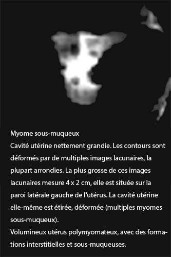 Fibrome 4