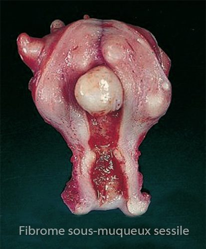 fibromes utérins