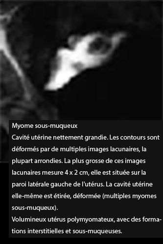 Fibrome 5