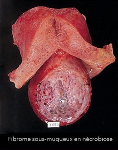 fibromes utérins