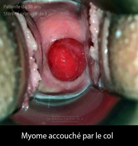 fibromes utérins