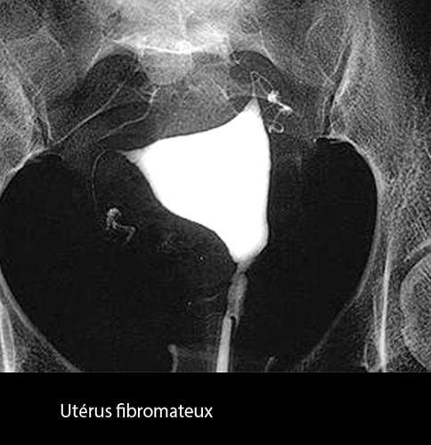 Fibrome 8