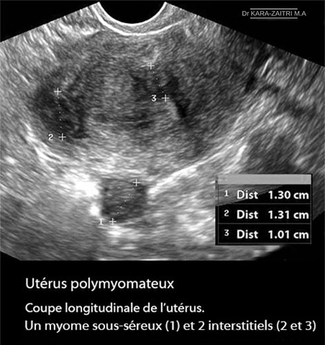 fibromes utérins