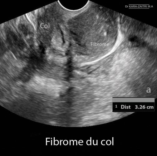 Fibrome du col 1