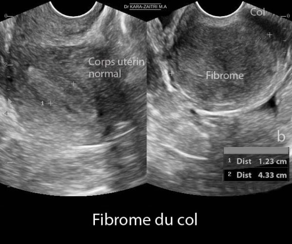 Fibrome du col 2