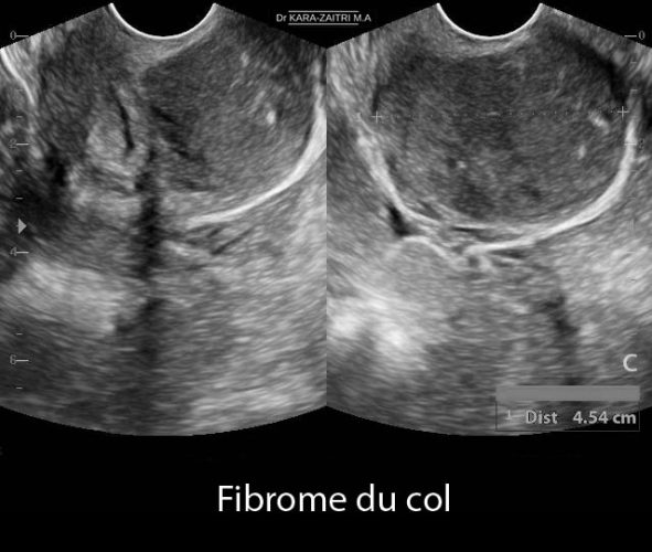 Fibrome du col 3