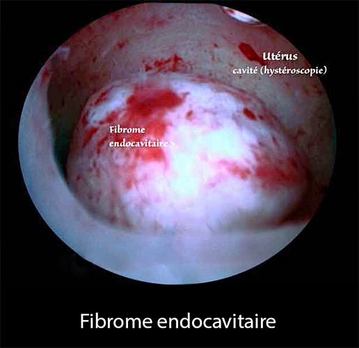 Fibrome intracavitaire 1