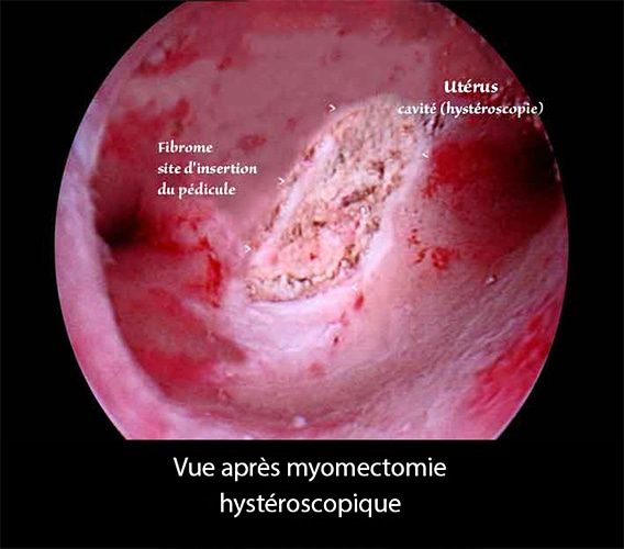 Fibrome intracavitaire 2