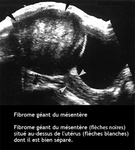 Fibrome mésentère_écho