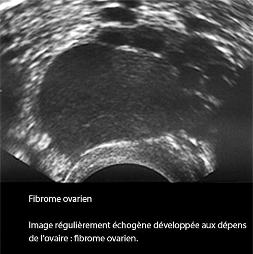 Fibrome ovarien_écho