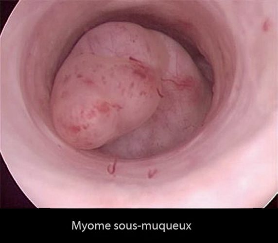 Fibrome sous-muqueux