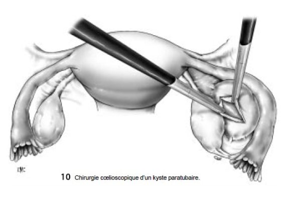Fig10_kystectomie_coelio