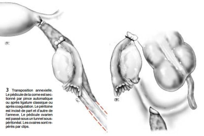 Fig3_transposition annexielle