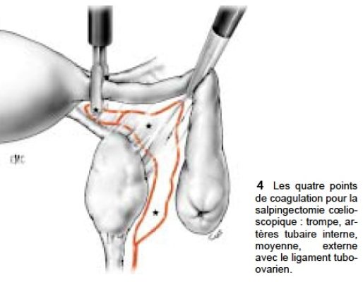 Fig4_salpingectomie coelio