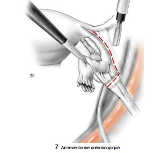 Fig6_annexectomie coelio