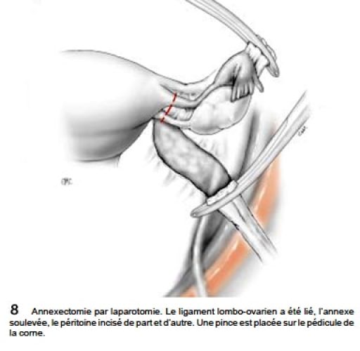 Fig8_annexectomie laparo