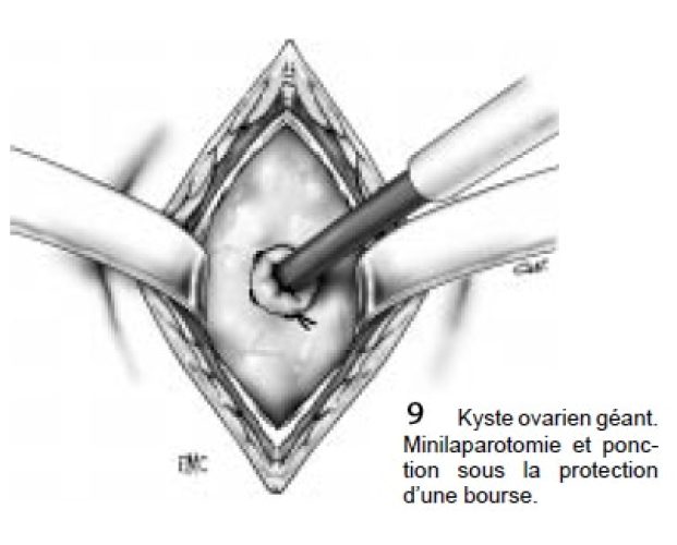 Fig9_kystectomie_minilaparo