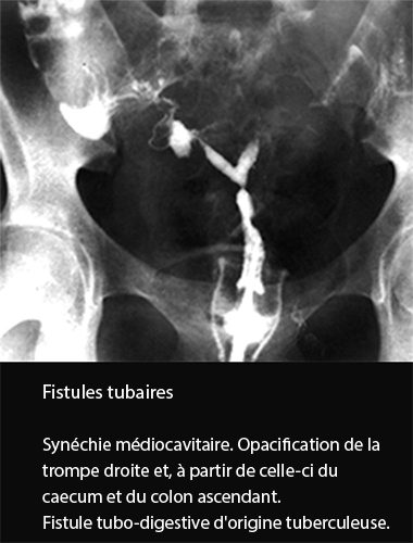 Fistules tubaires 1