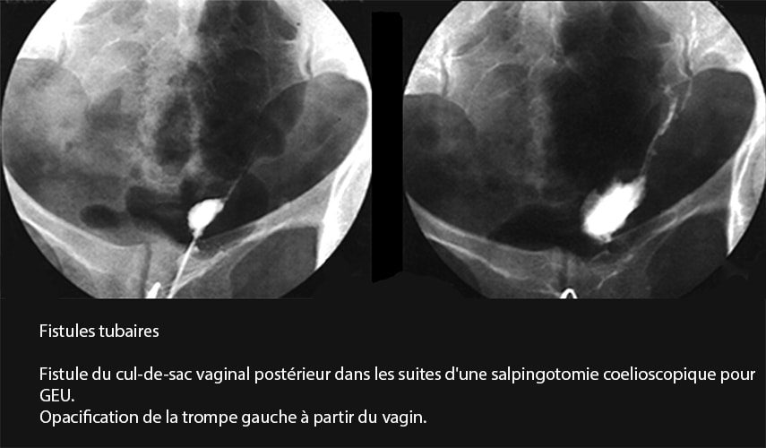 Fistules tubaires 2