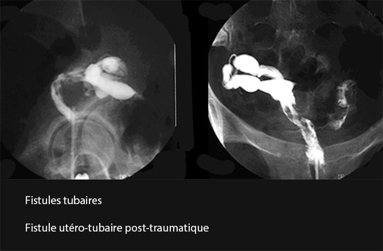Fistules tubaires 3