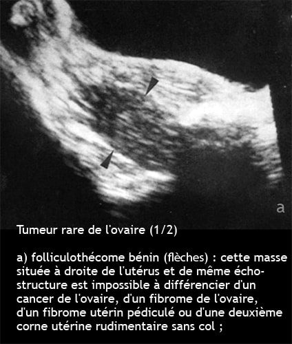 Folliculothécôme ovaire — tumeur bénigne ovarienne stromale