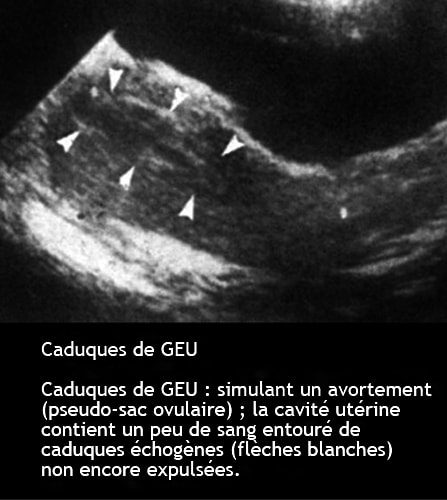 GEU caduques — caduque déciduale grossesse extra-utérine