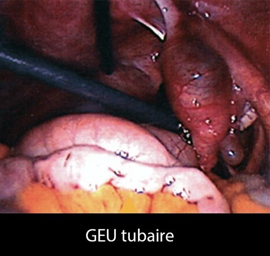 GEU tubaire