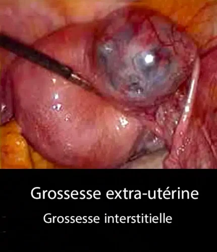 GEU_interstitielle_coelio