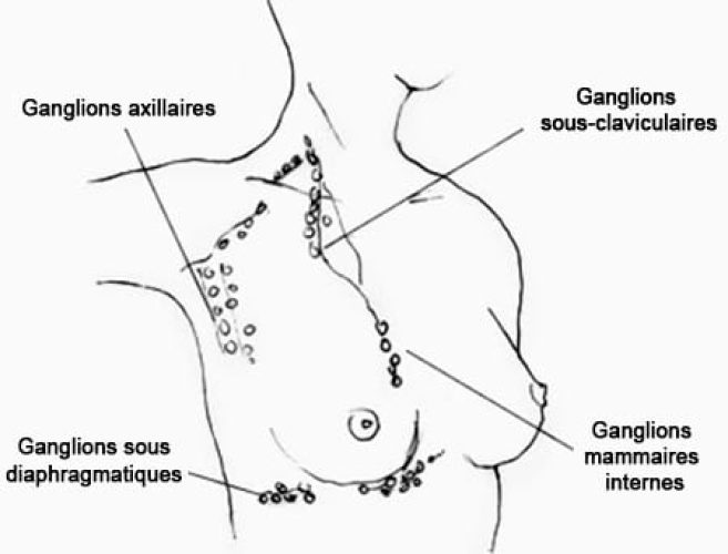 Ganglions du sein