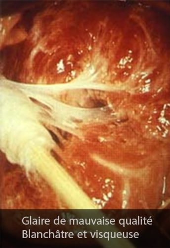 Glaire cervicale visqueuse — aspect microscopique