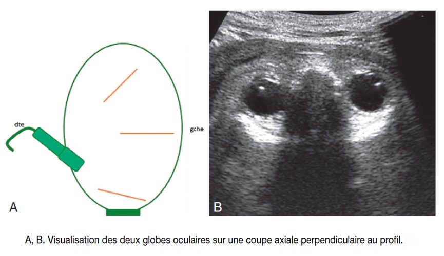 Globes oculaires fœtaux — échographie ophtalmique mesure diamètre oculaire