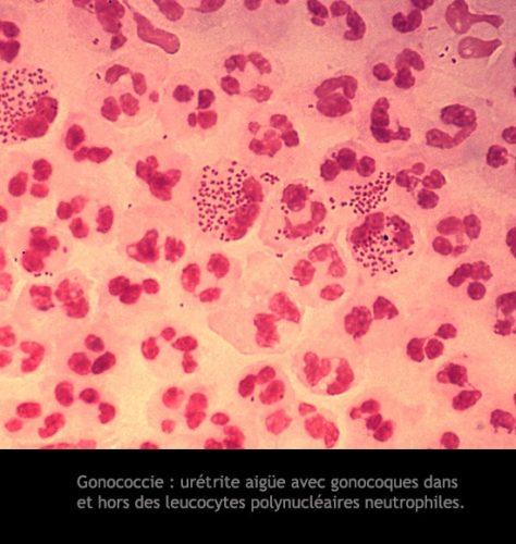 Gonocoque 3