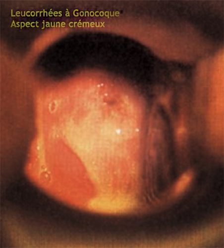 Gonocoque_leucorrhée