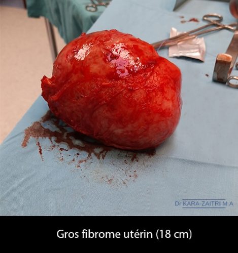 fibromes utérins