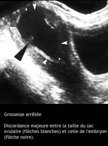 Grossesse arrêtée — œuf clair embryon non viable échographie 2