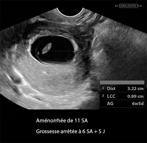 grossesse arrêtée