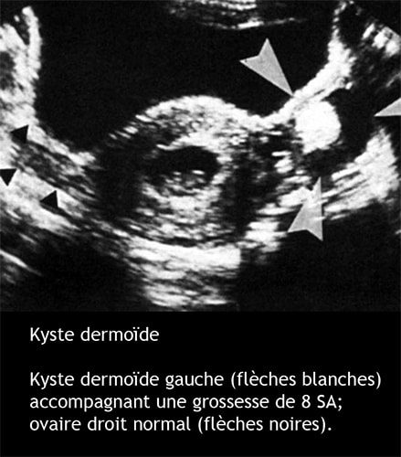 Gross et kyste 3