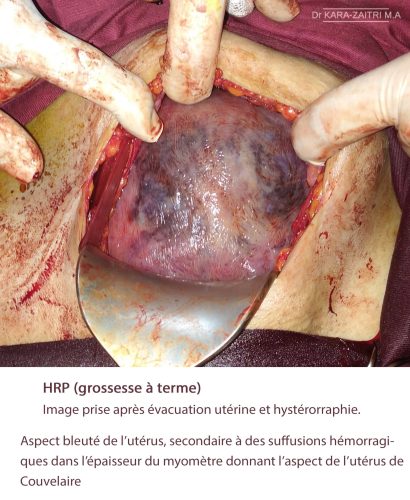 Hématome rétro-placentaire (HRP)