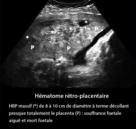 HRP1