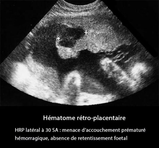 HRP4