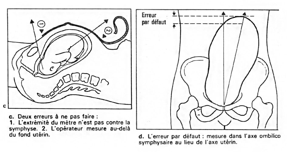 Hauteur utérine — mesure obstétricale croissance fœtale 2