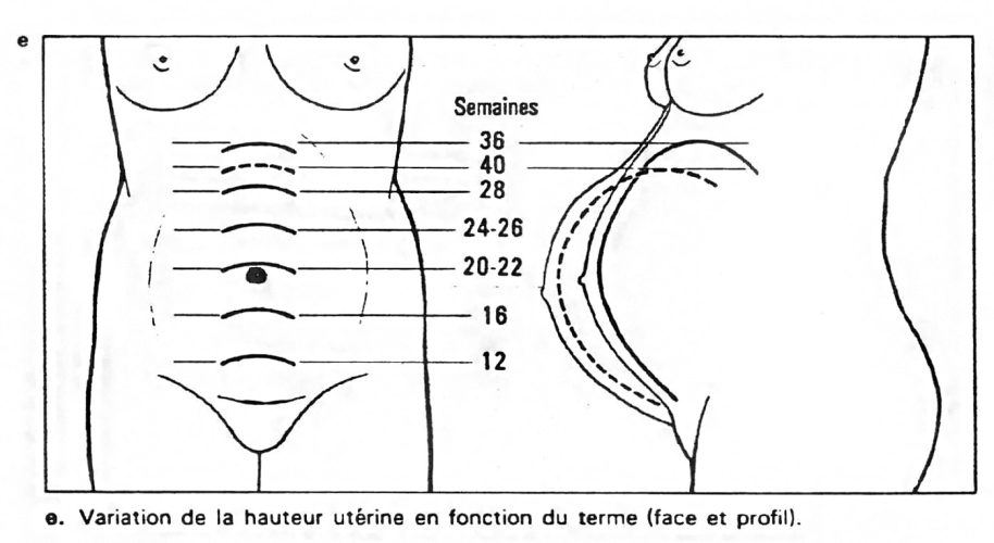 Hauteur utérine — mesure obstétricale croissance fœtale 3