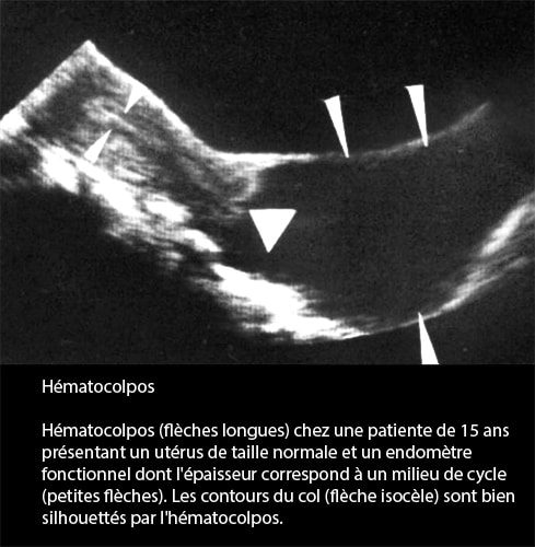 Hématocolpos 1