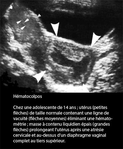 Hématocolpos 2