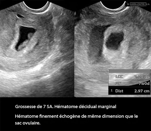 hématome décidual