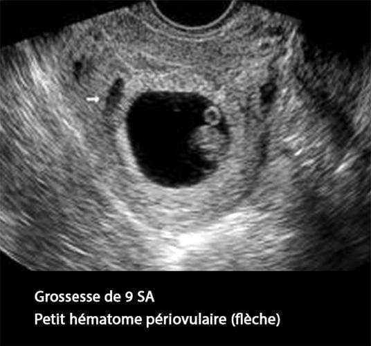 hématome décidual