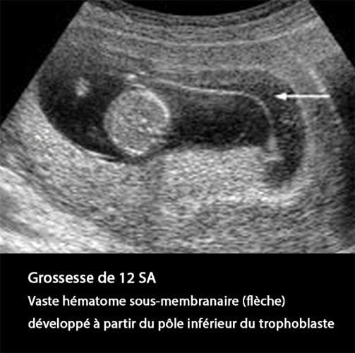 hématome décidual