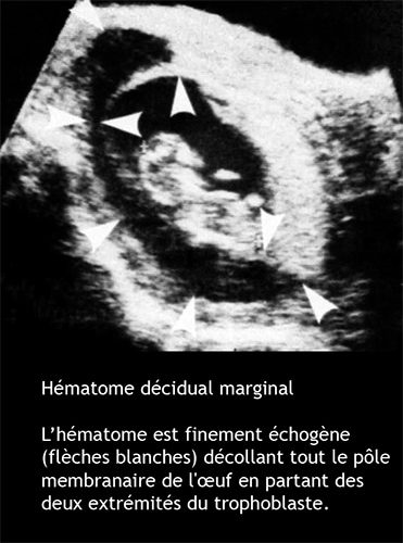 hématome décidual