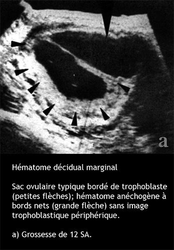 hématome décidual