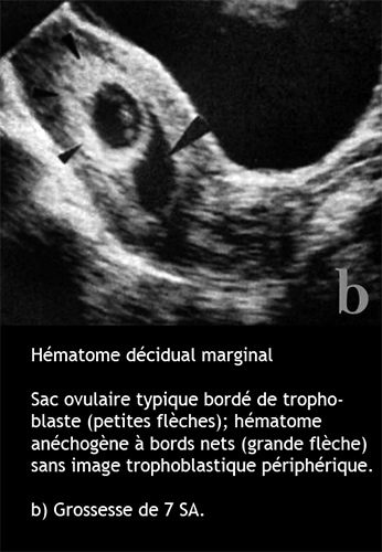 hématome décidual